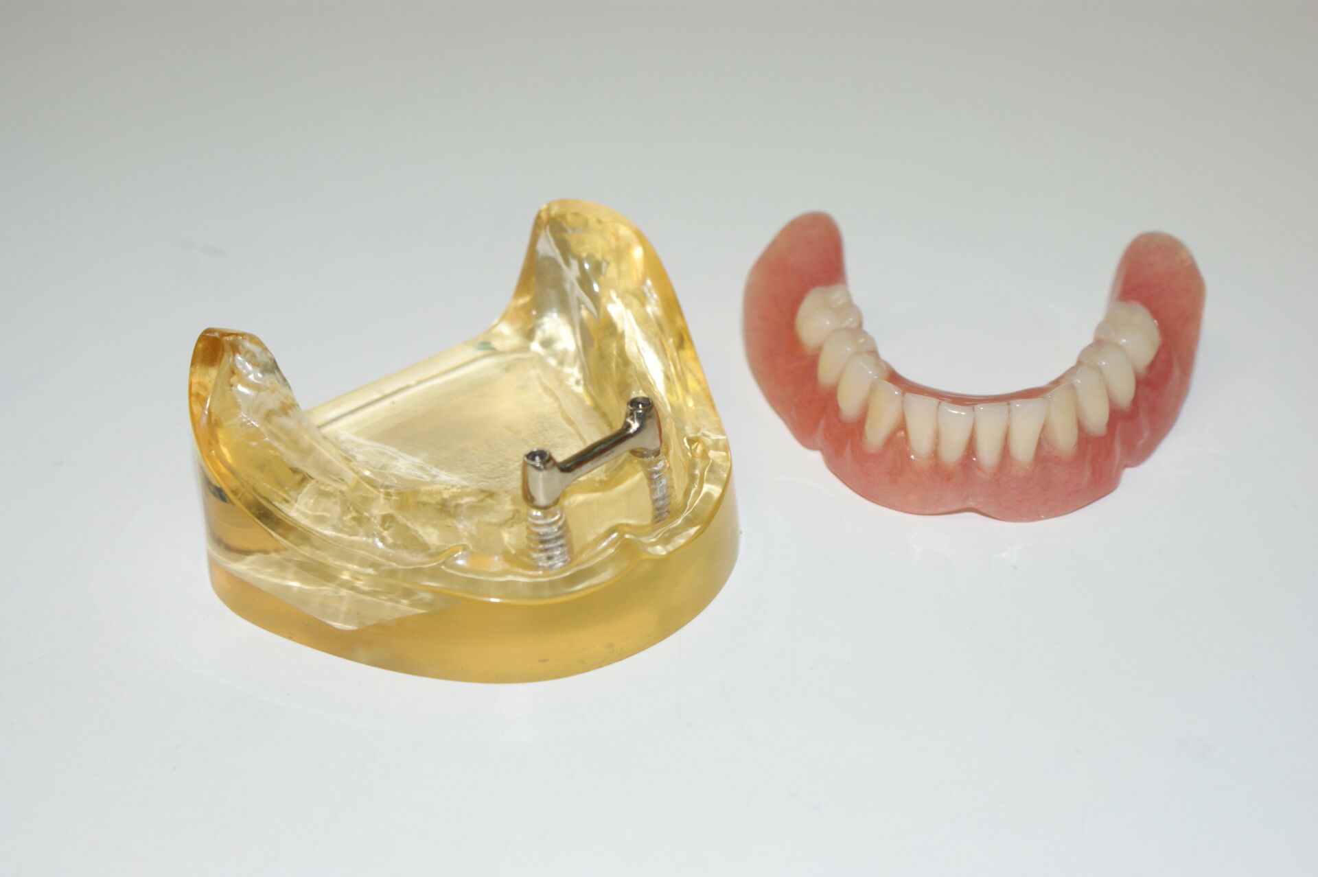 Herausnehmbarer Zahnersatz auf Implantaten
